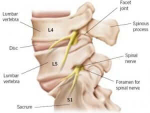 Epidural steroid injection for cervical spinal stenosis